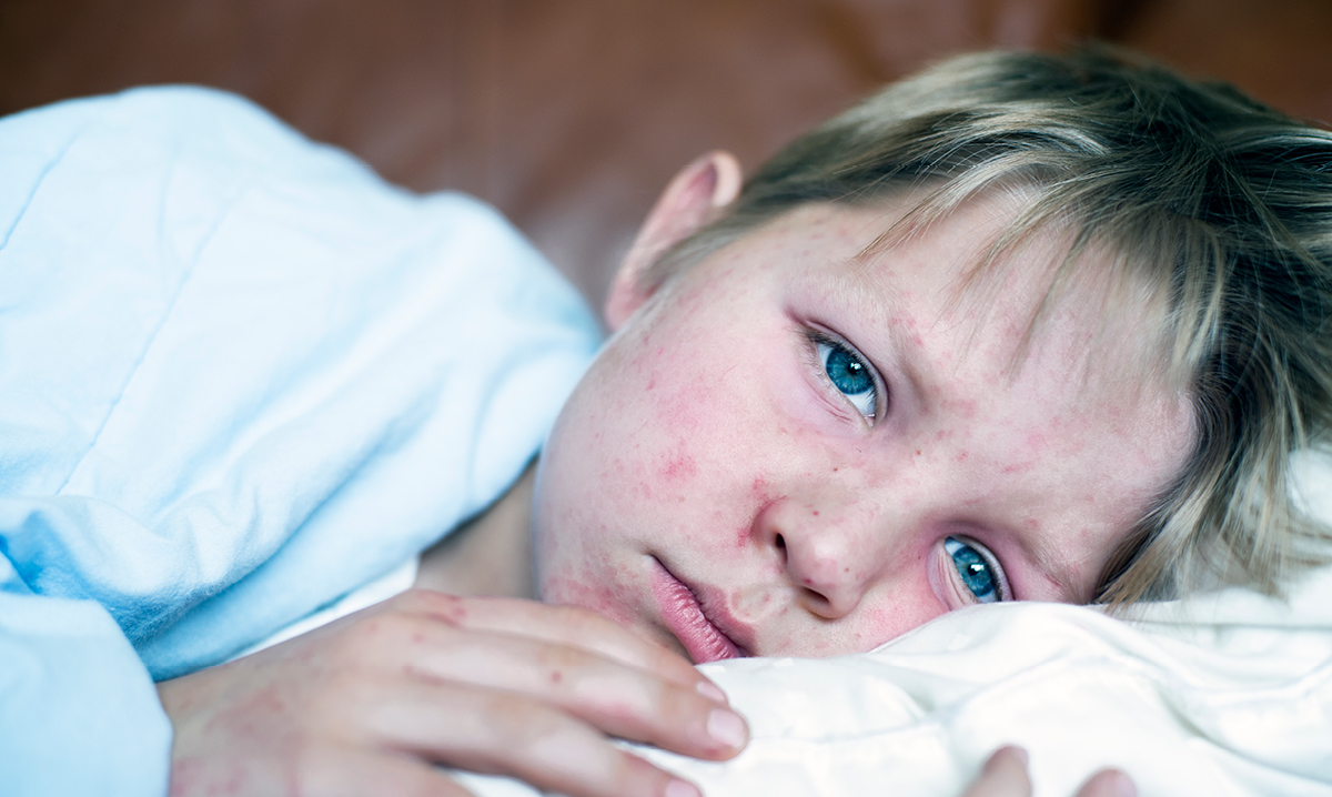 A sick child lying in bed with a fever and a measles rash on their face. The child appears tired and unwell, showing common symptoms of measles.