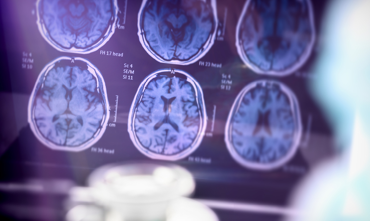 An MRI image of a brain