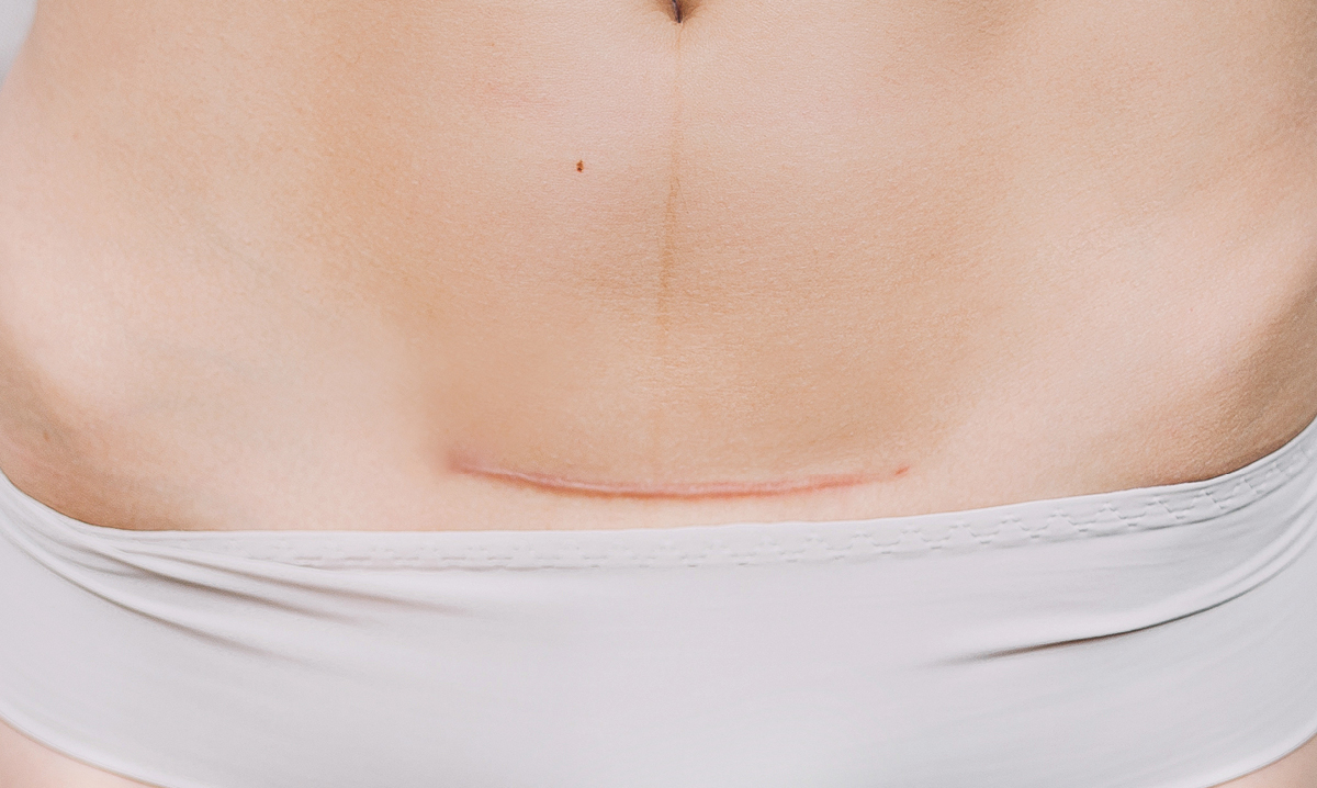 c-section scar