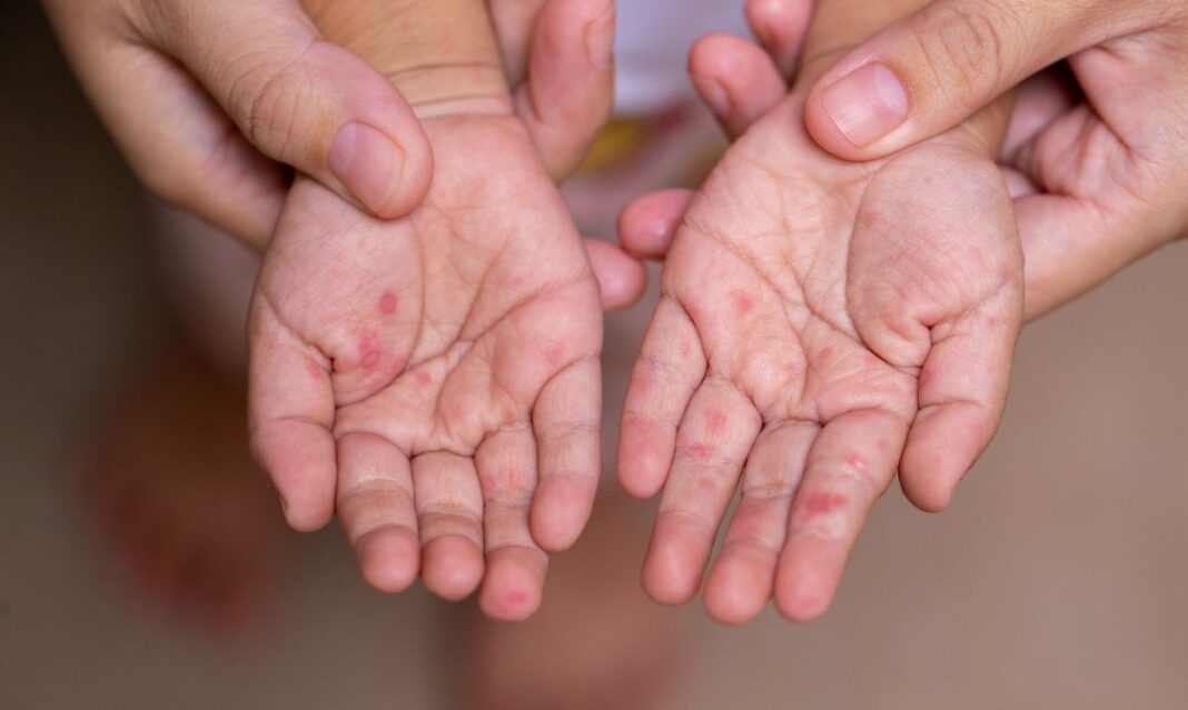 Child hands with hand foot and mouth disease rash showing red spots and blisters on palms a common contagious viral illness in kids